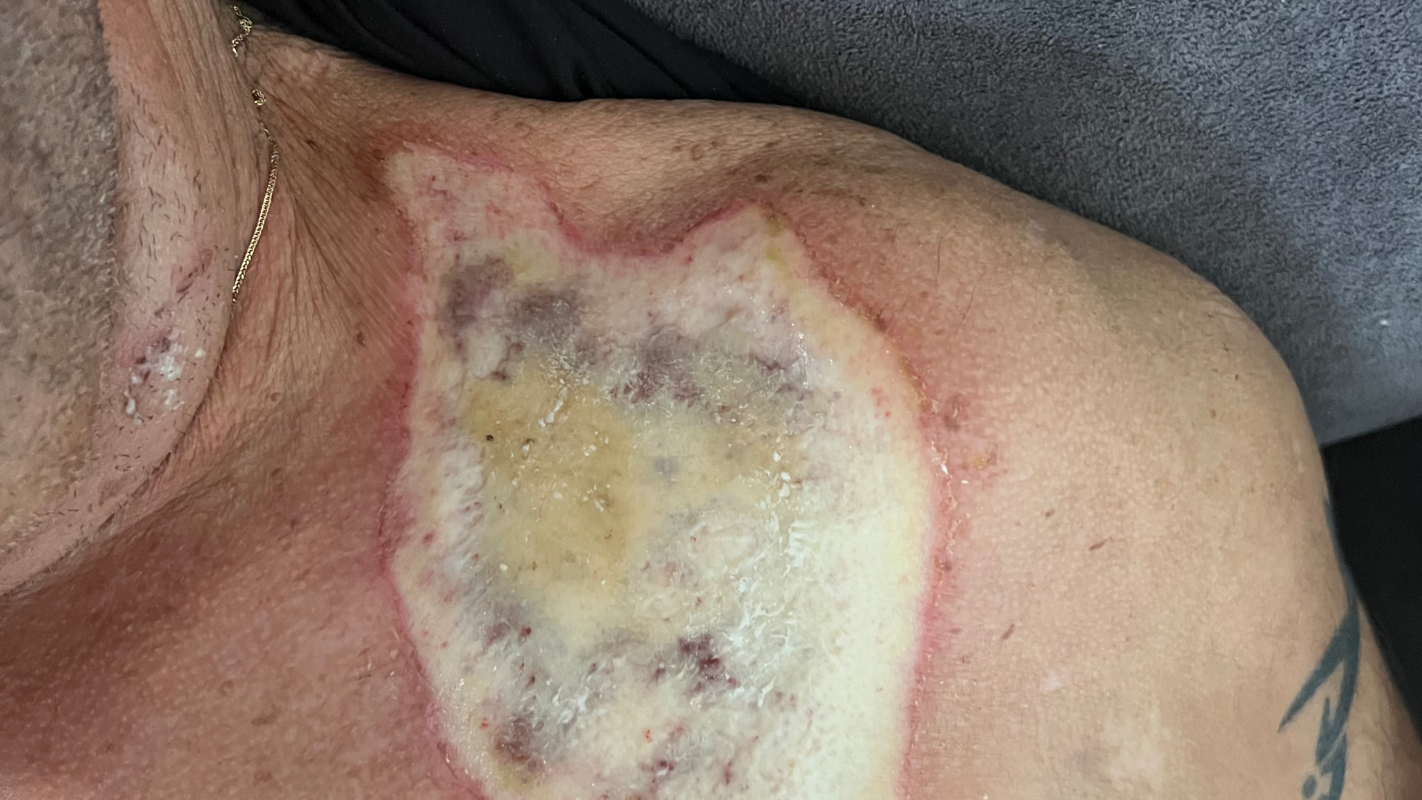 Skin graft for a third degree burns
