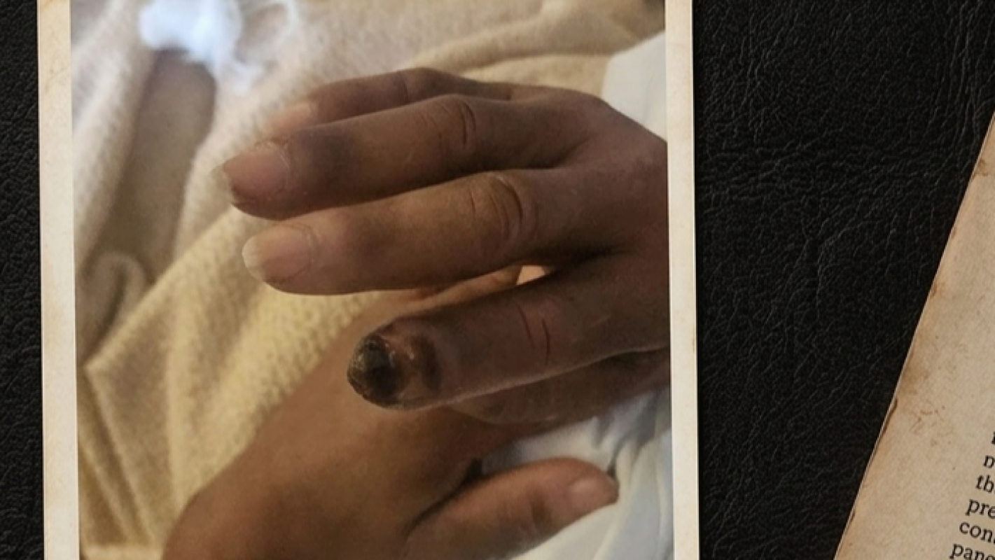 Diagnosed with raynaud and scleroderma