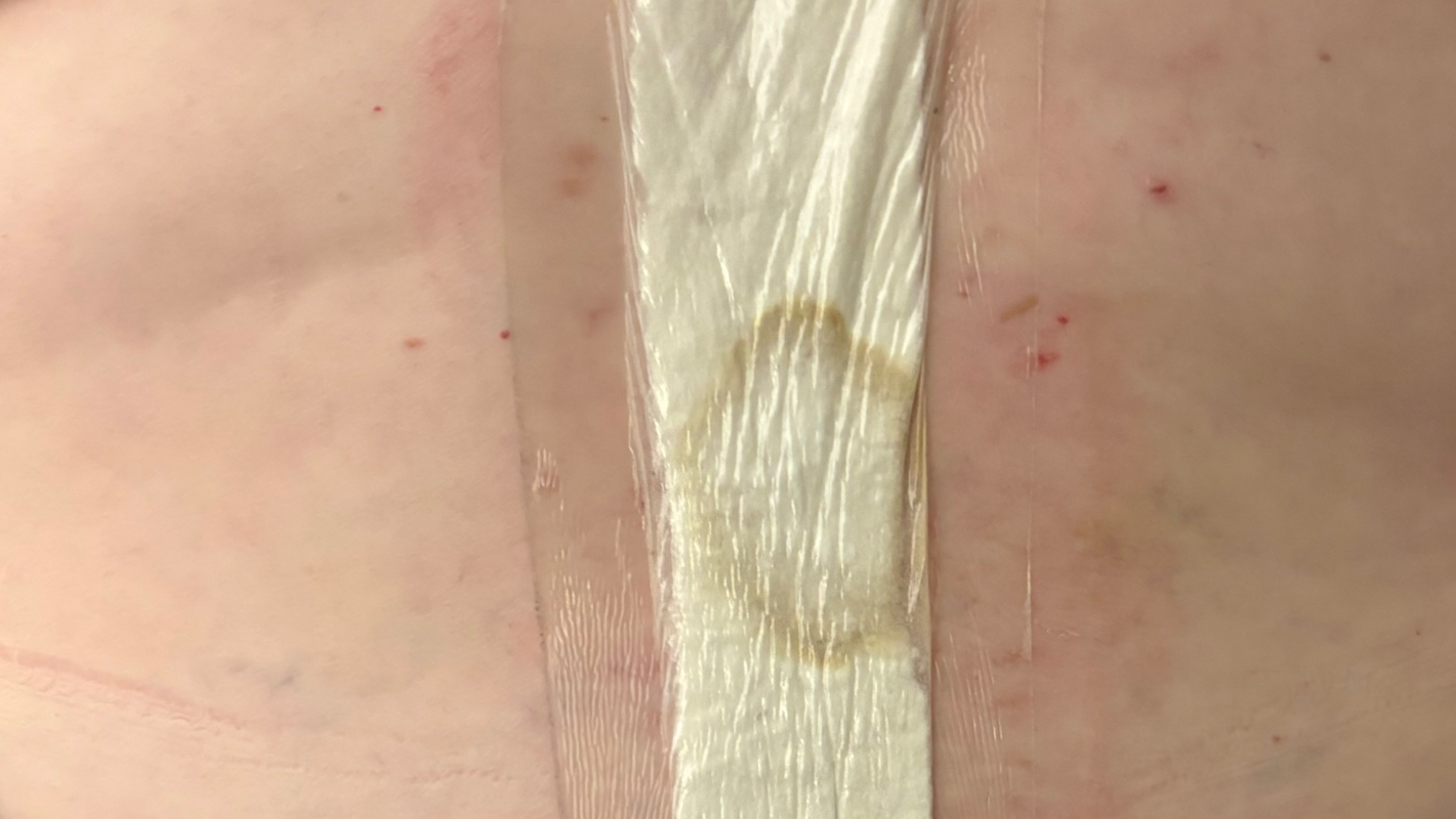 Traumatic Spinal Injury