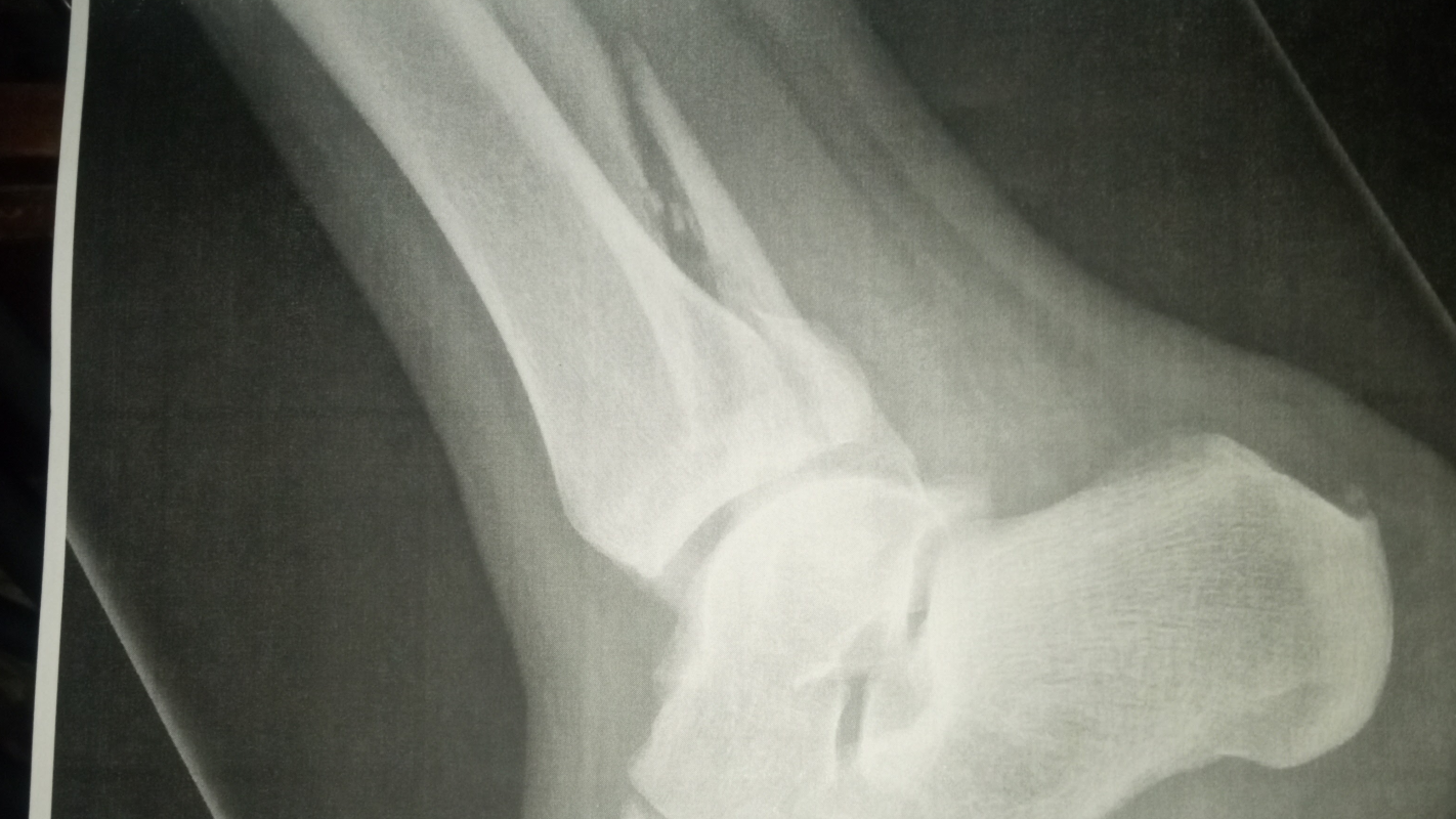 Leg surgery