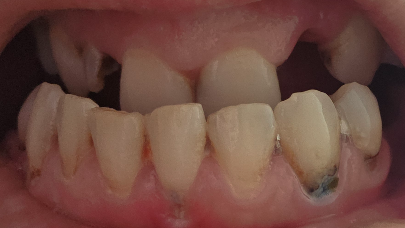 Dental Implants