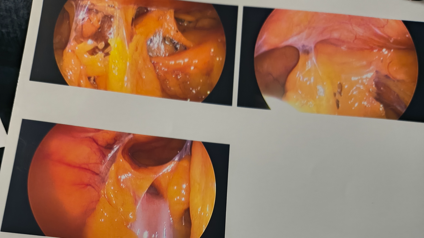 Endometriosis recovery