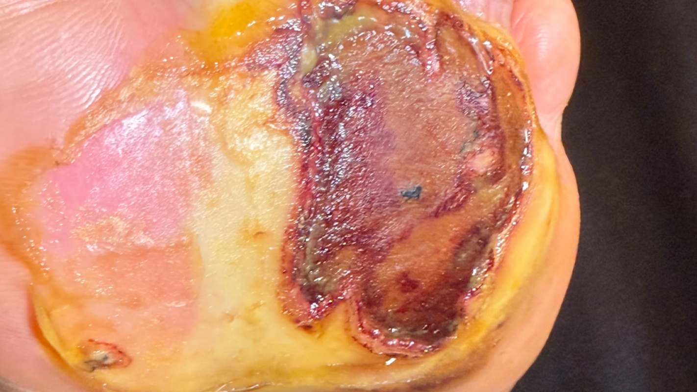 Diabetic patient feet injury