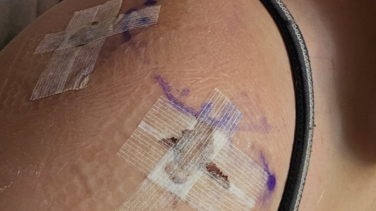 Help Oliver Mom Recover from shoulder surgery