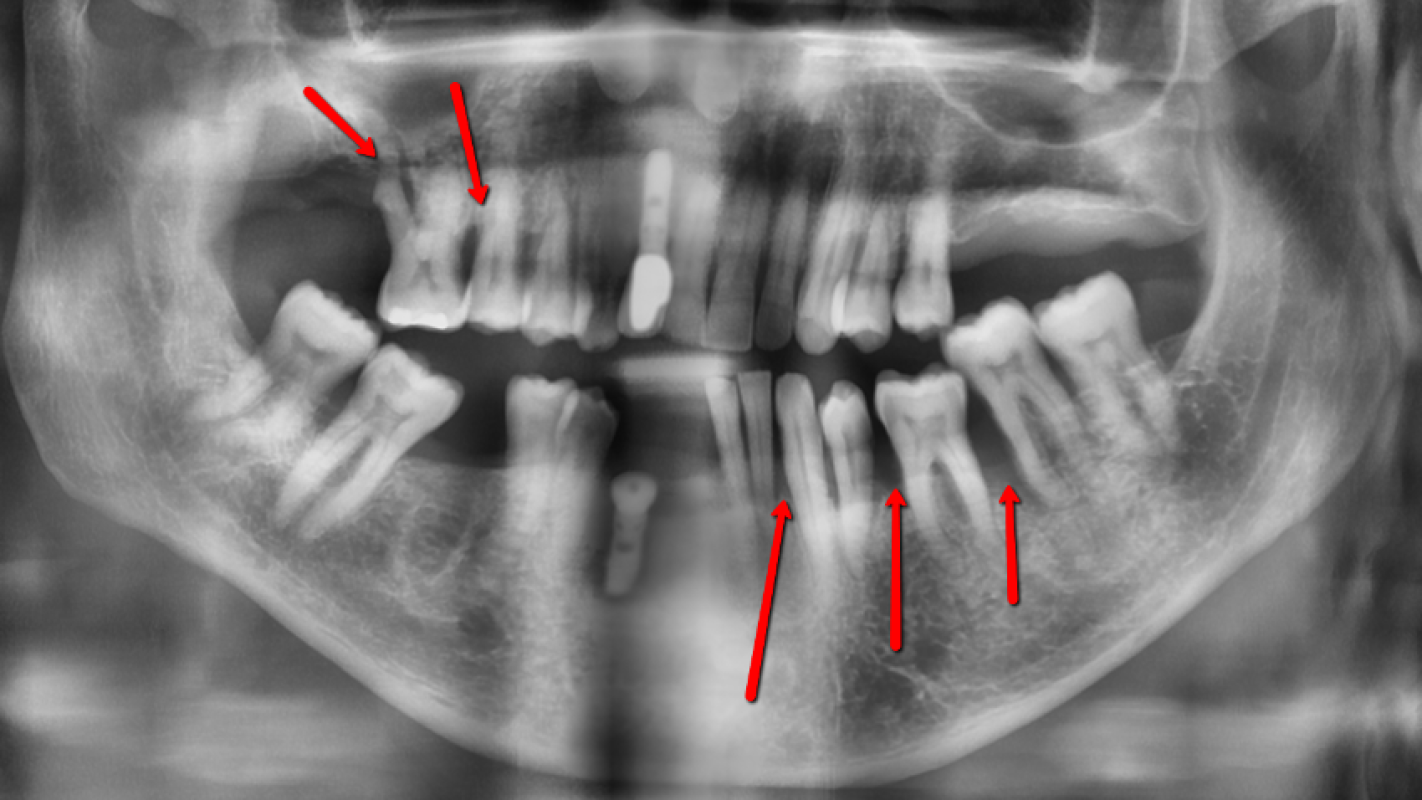 Emergency tooth surgery and tooth implants