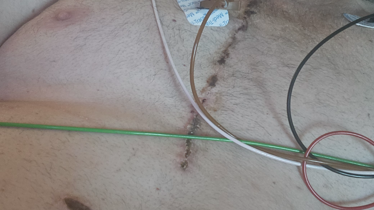 Aorta dissection surgery