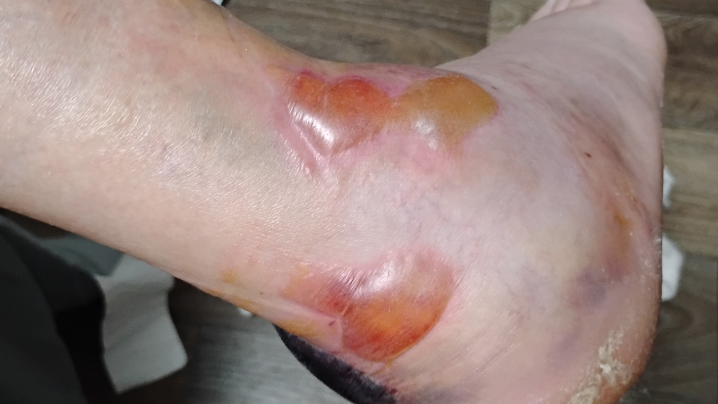 Husband's Broken foot/Foot Surgery