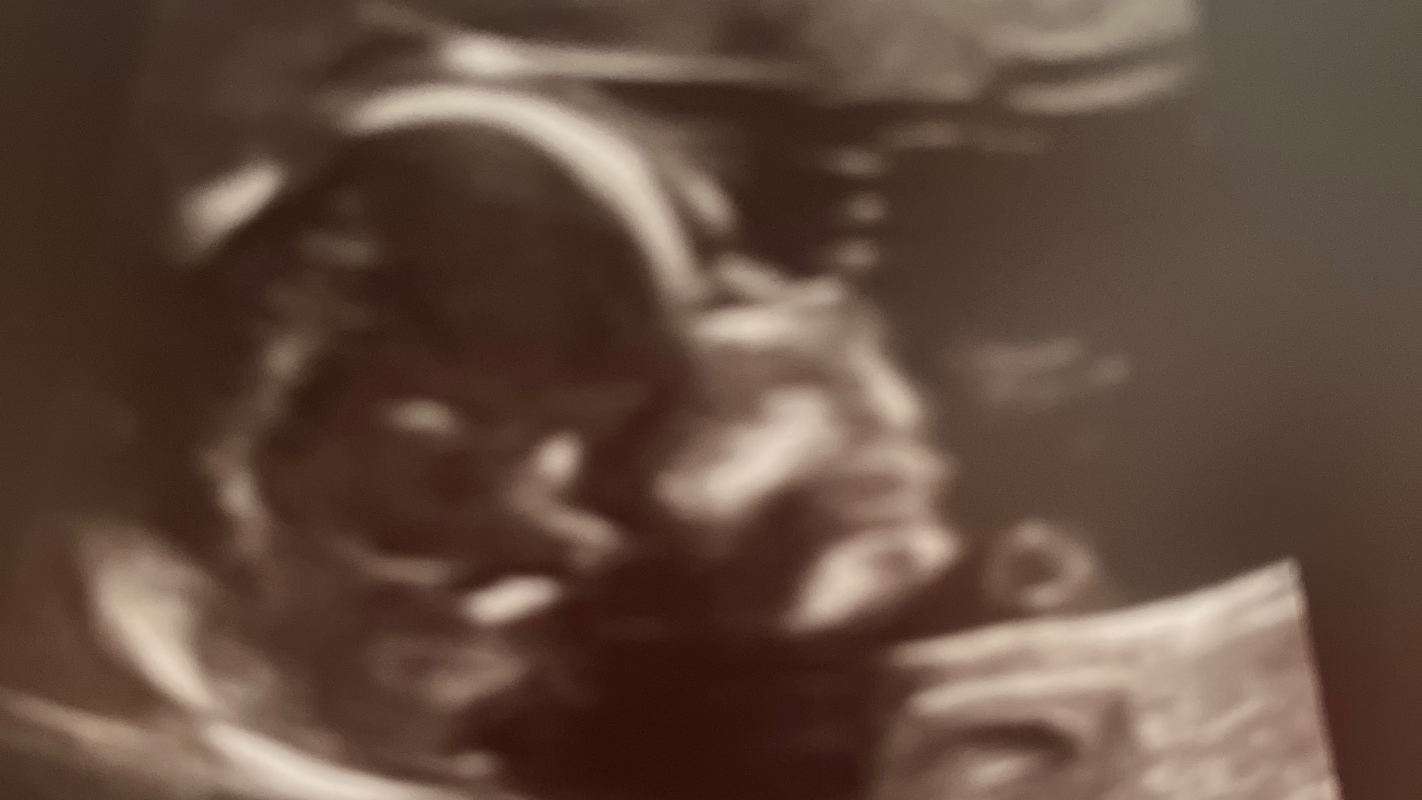 Baby has CAVC