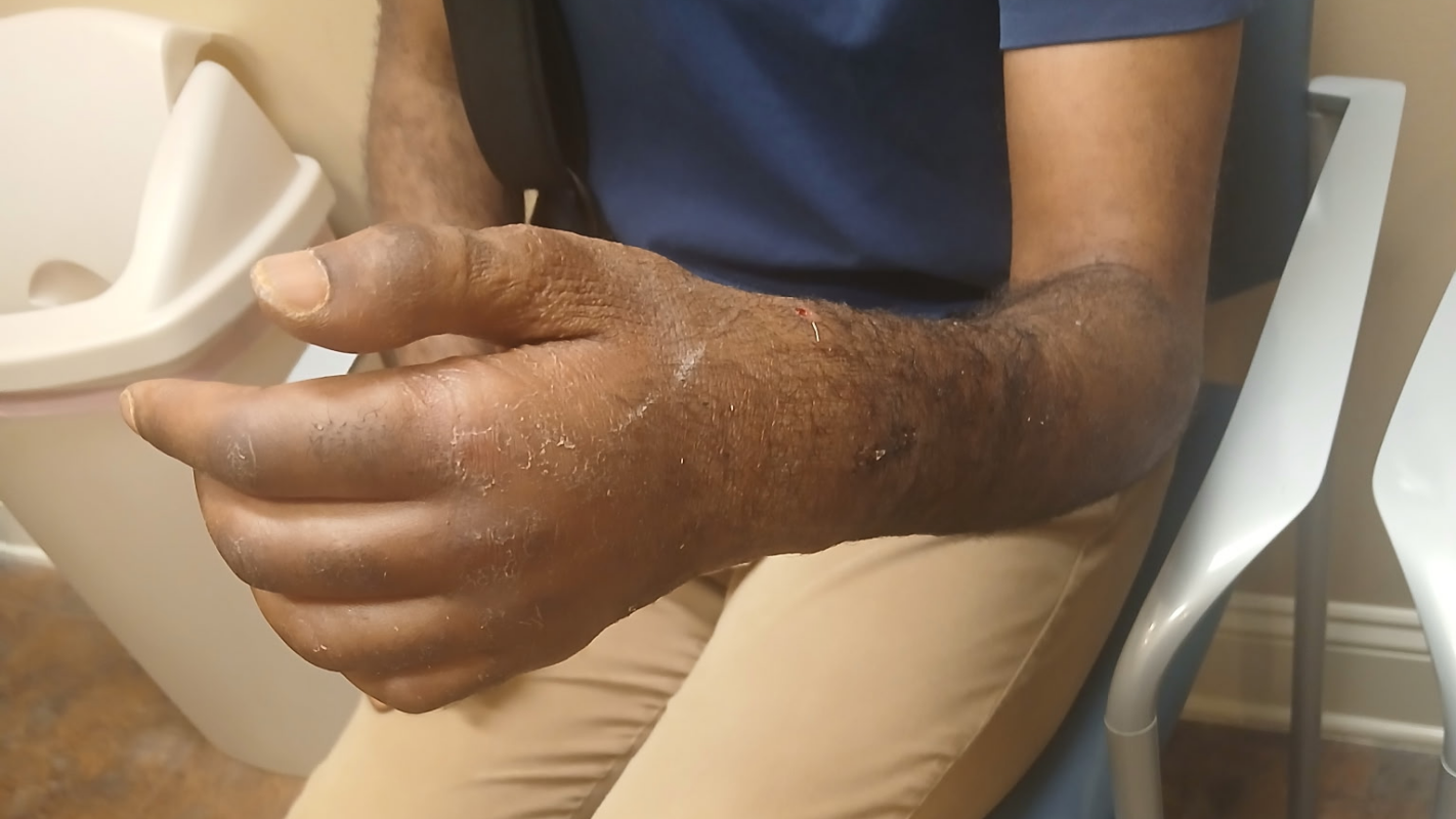 Hospital and Hand surgery bill