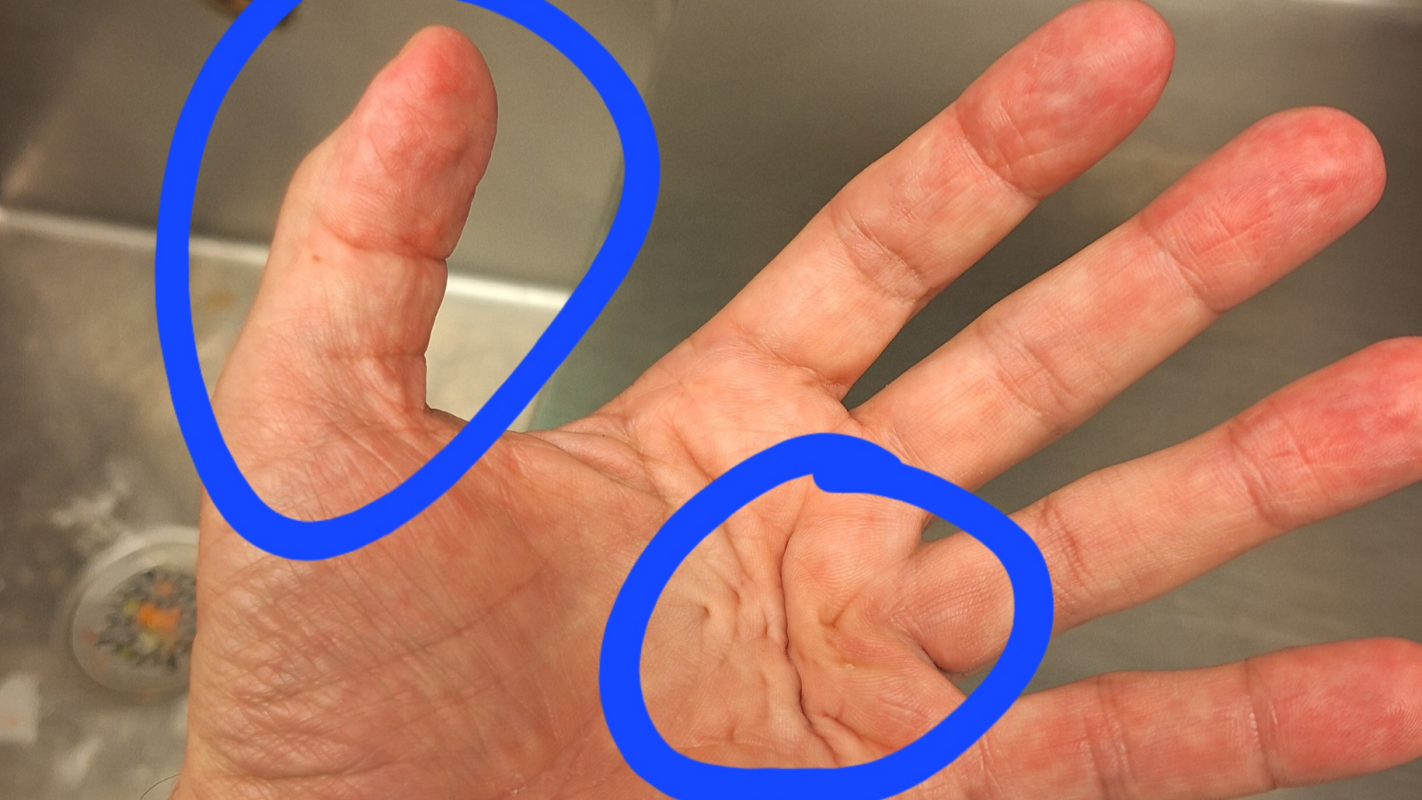 Cover missing income while I am out of work after surgery