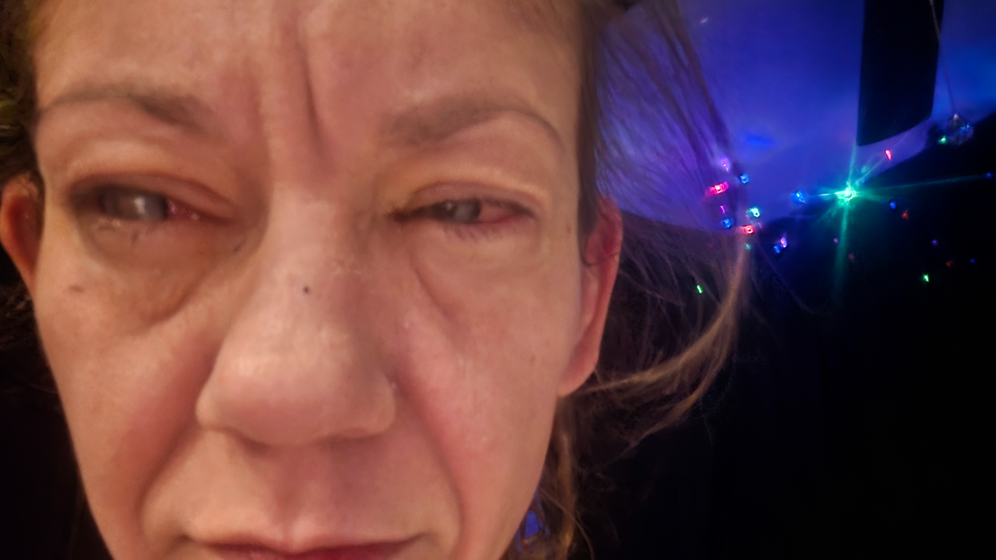 I just want to see again.  Cornea transplant