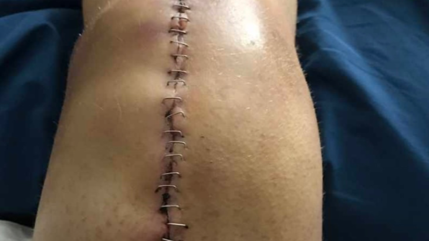 Back Surgery (Accident Victim)