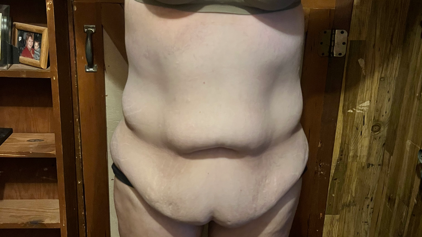 Skin Removal Surgery