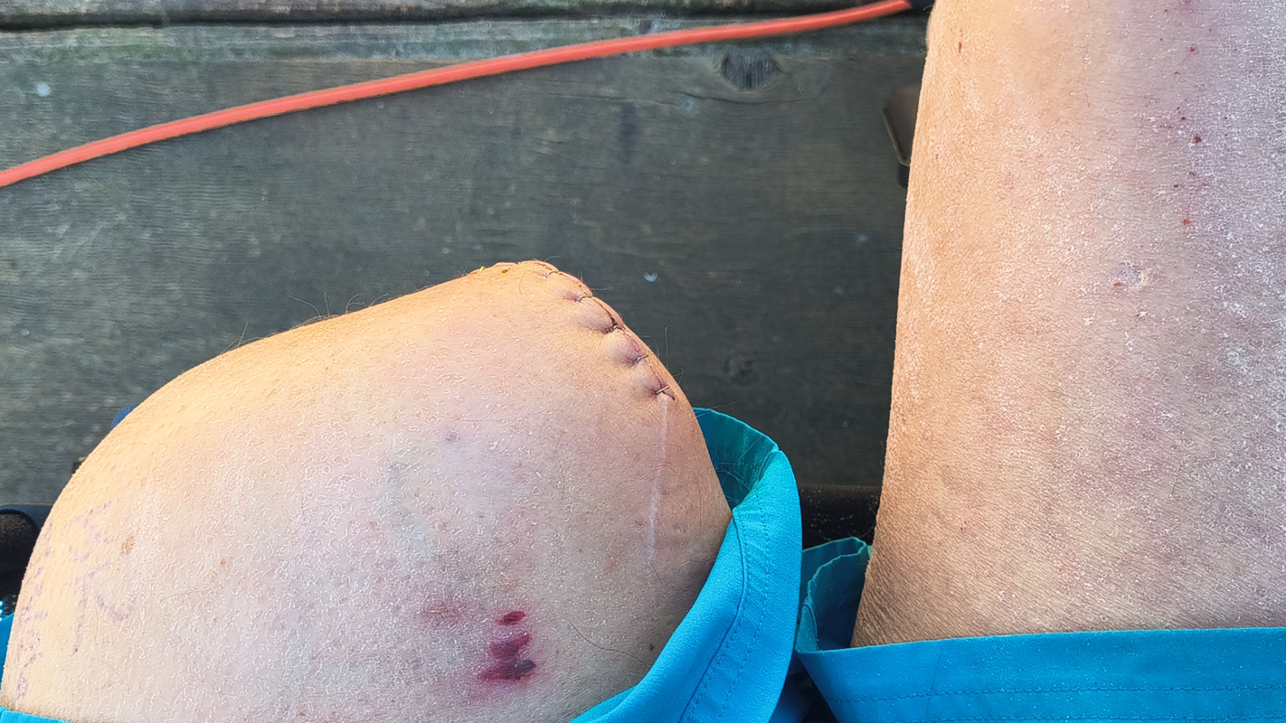 Living expenses and medical bills