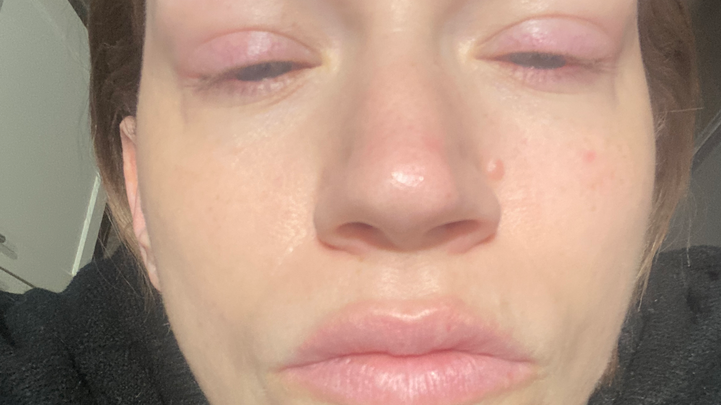 Lupus/Myositis Overlap Syndrome Help