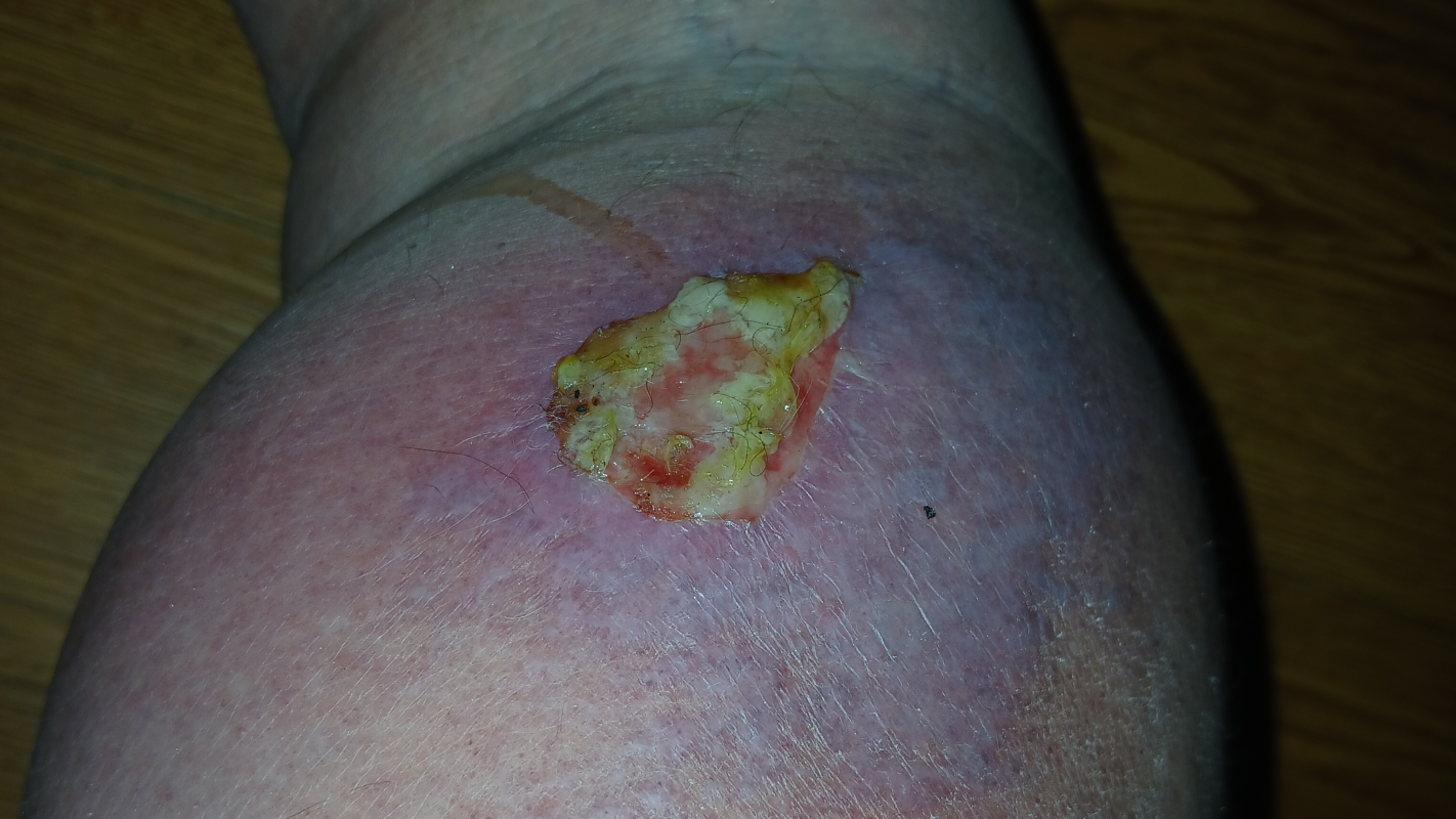 My son has lymphoma in both legs