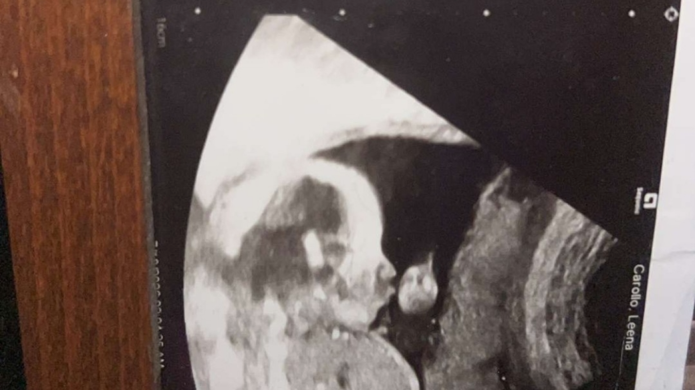 States away, a baby born to soon