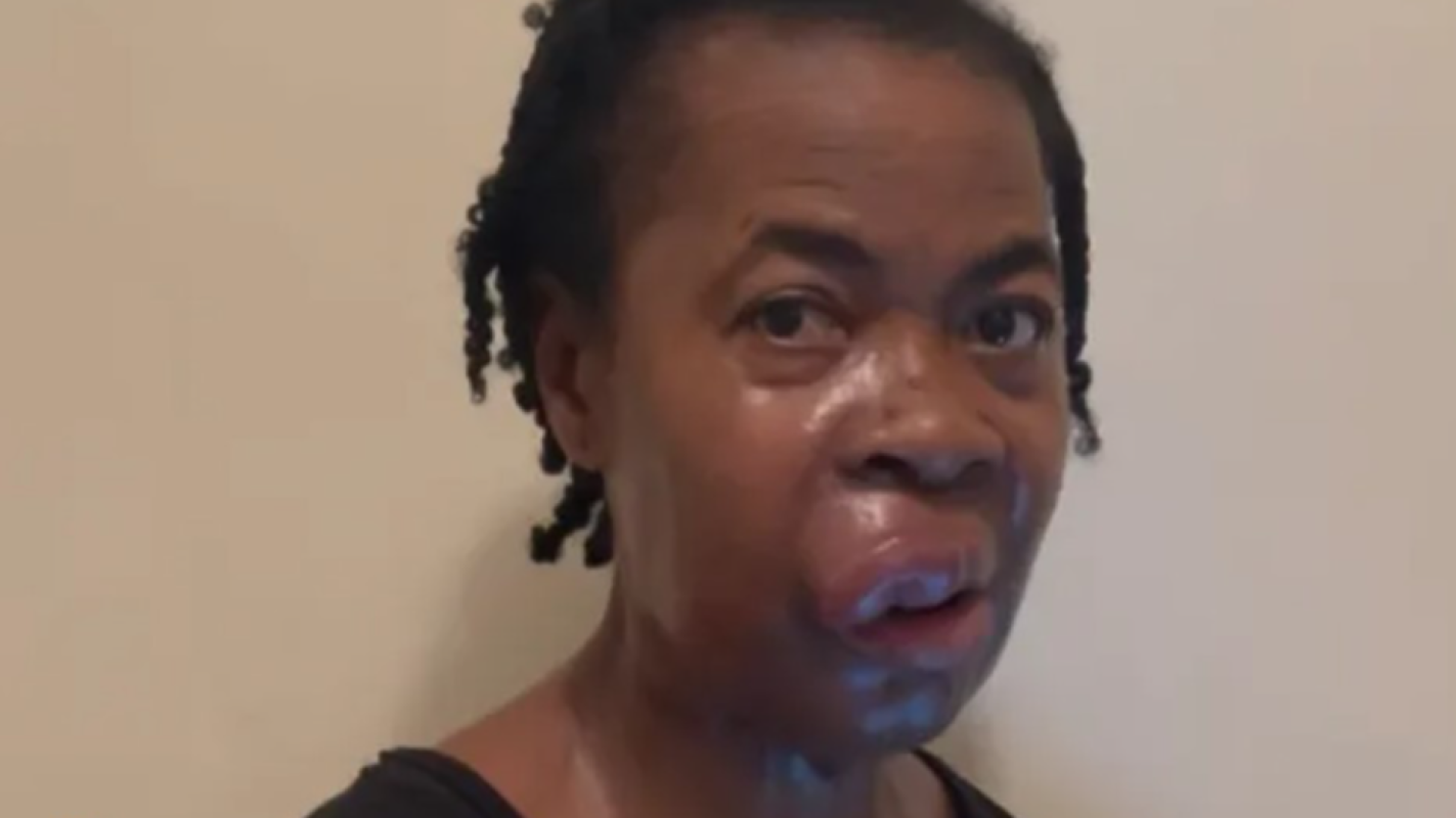 melanoma Cancer battle