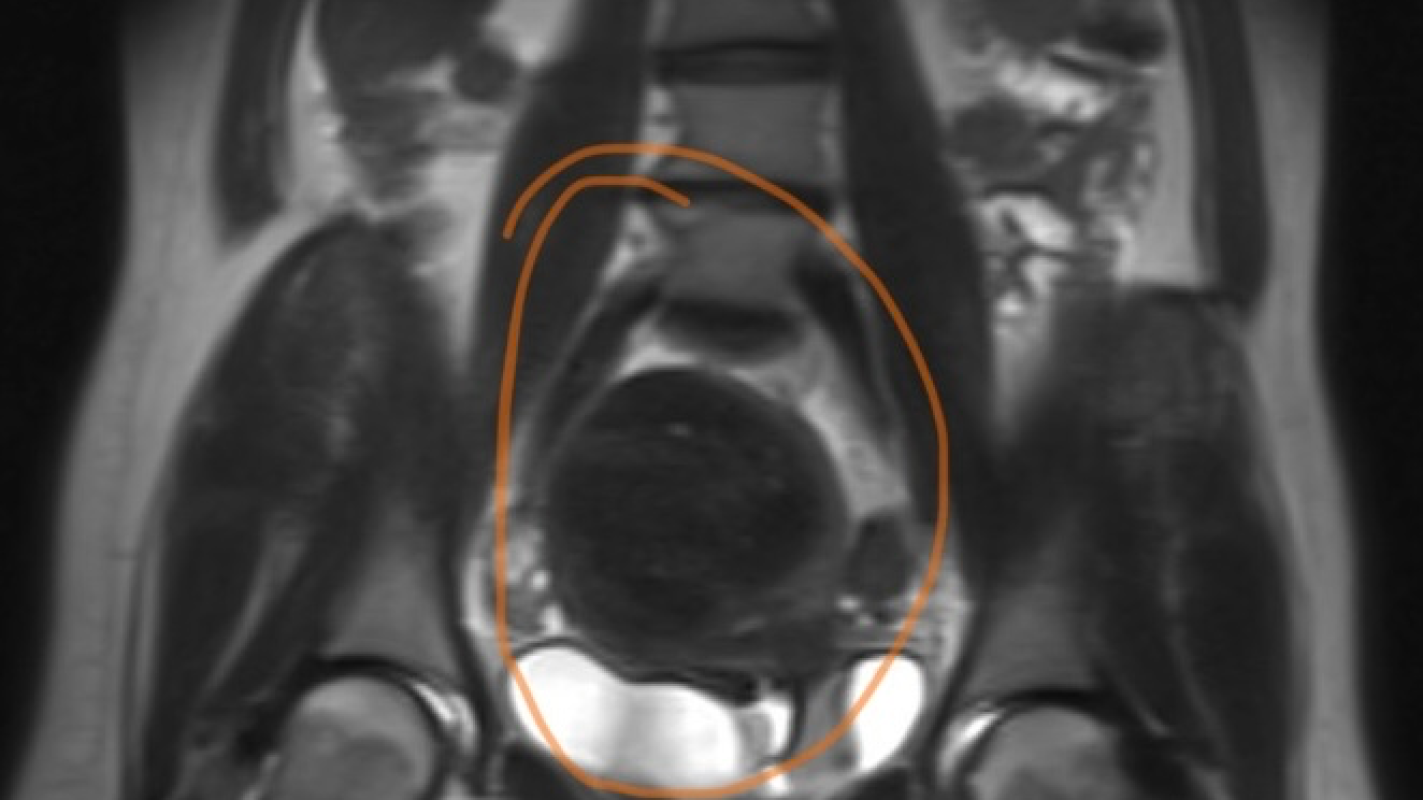 Post Hysterectomy Recovery