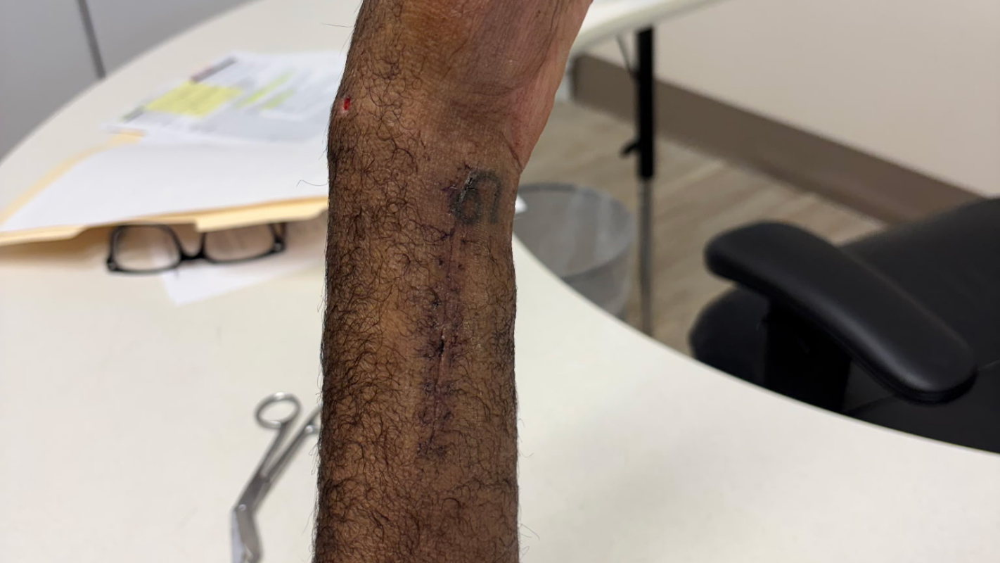 Hospital and Hand surgery bill