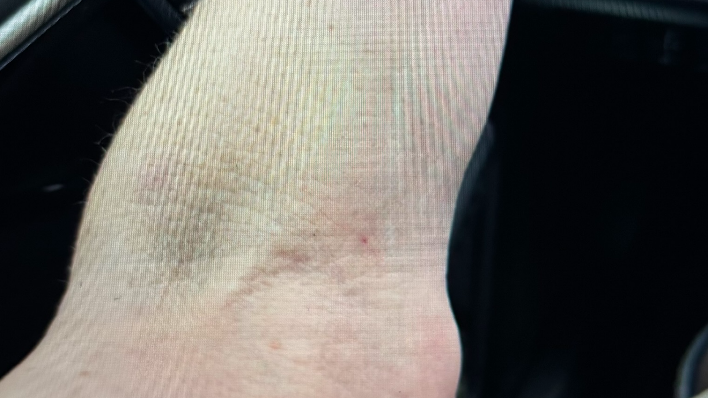 elbow surgery