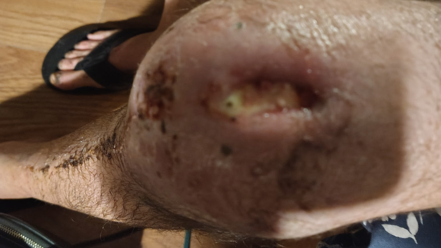 Homeless with severe medical conditions