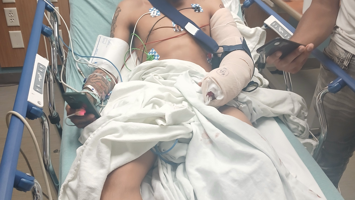 Alon & his recent Amputation