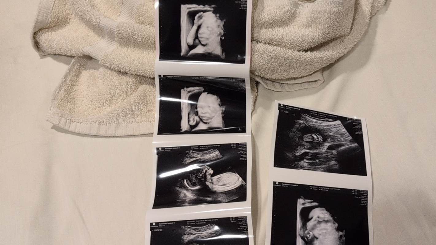 Newborn surgery