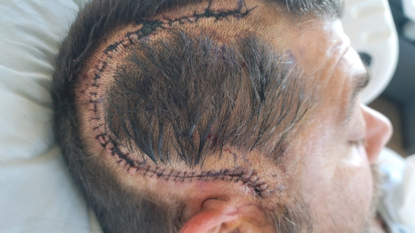 Stroke surviver going through hardship