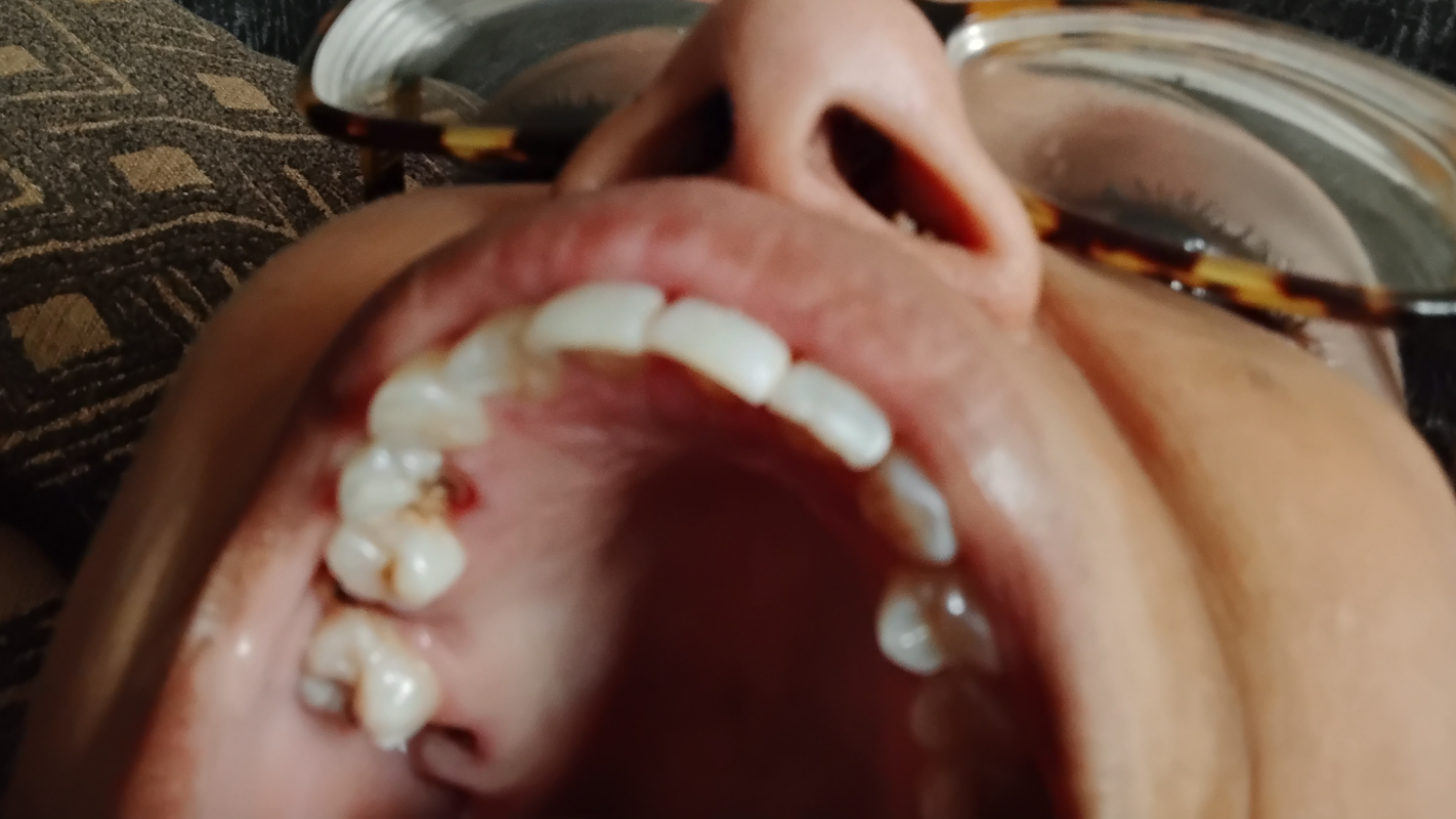 My teeth to be removed and dentures and bariatric vitamins