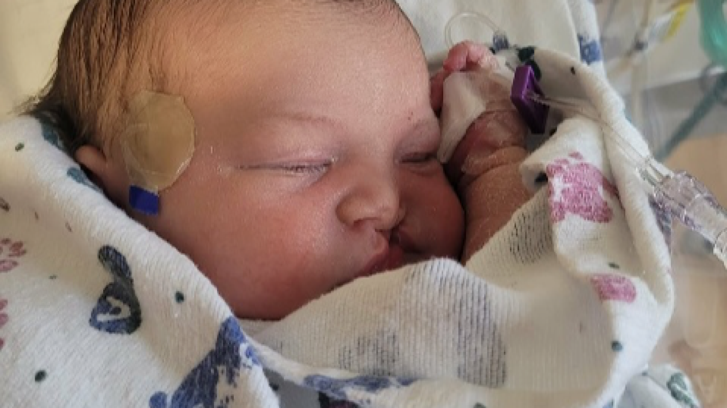 Cleft palate care for Baby Ruth