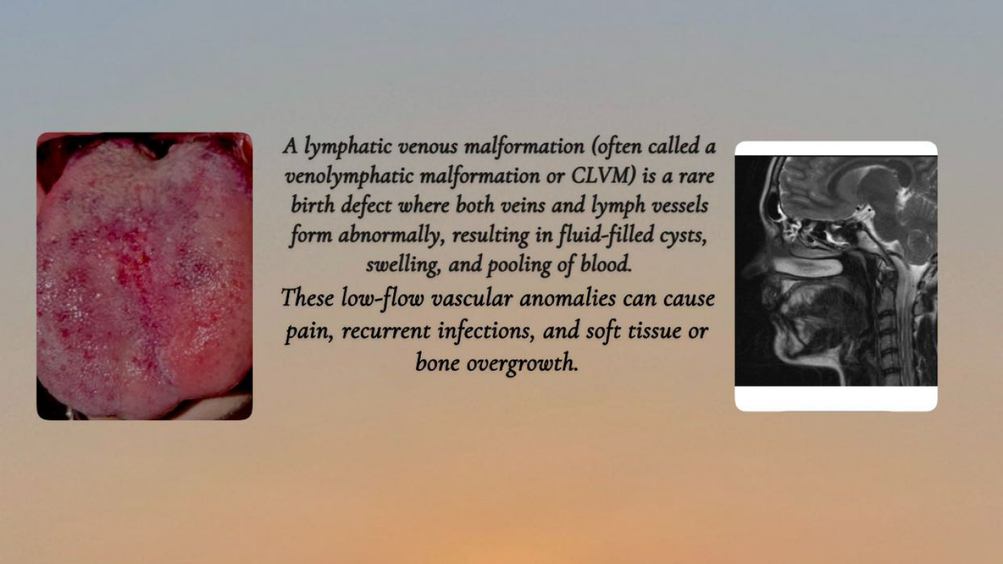 Lydia’s Video Conference for Lymphatic Venus Vascular Malformation Surgery