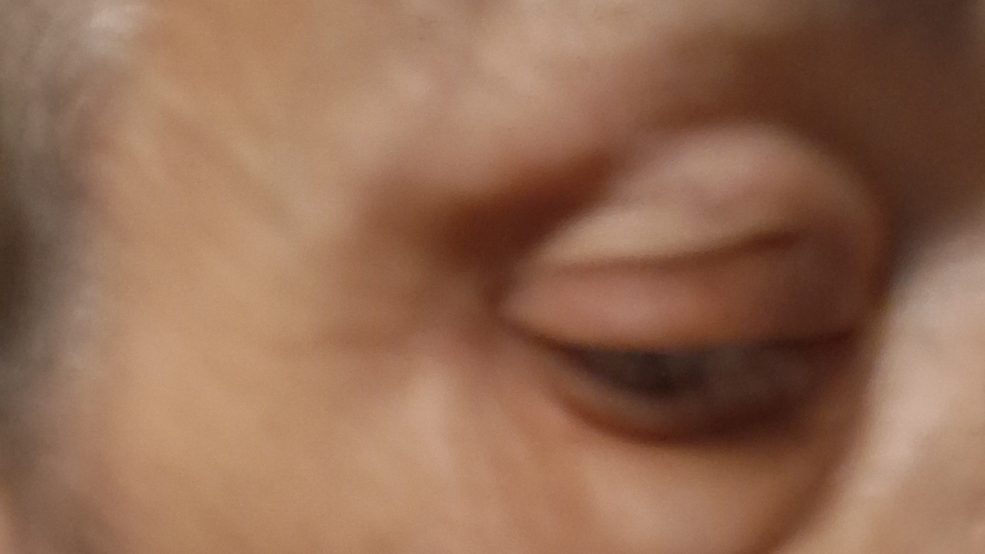 MACULAR DEGENERATION