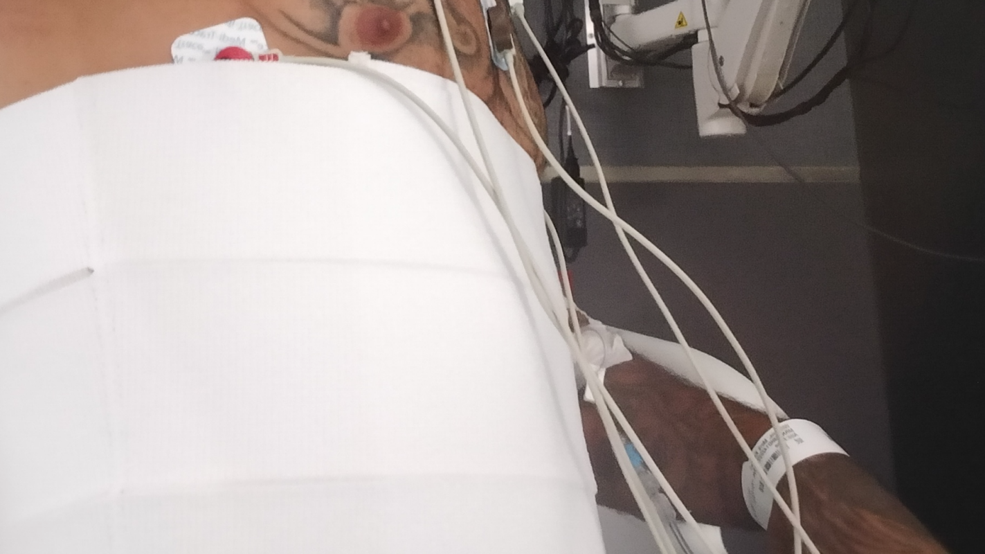 Surgery appendix removal, and need another surgery