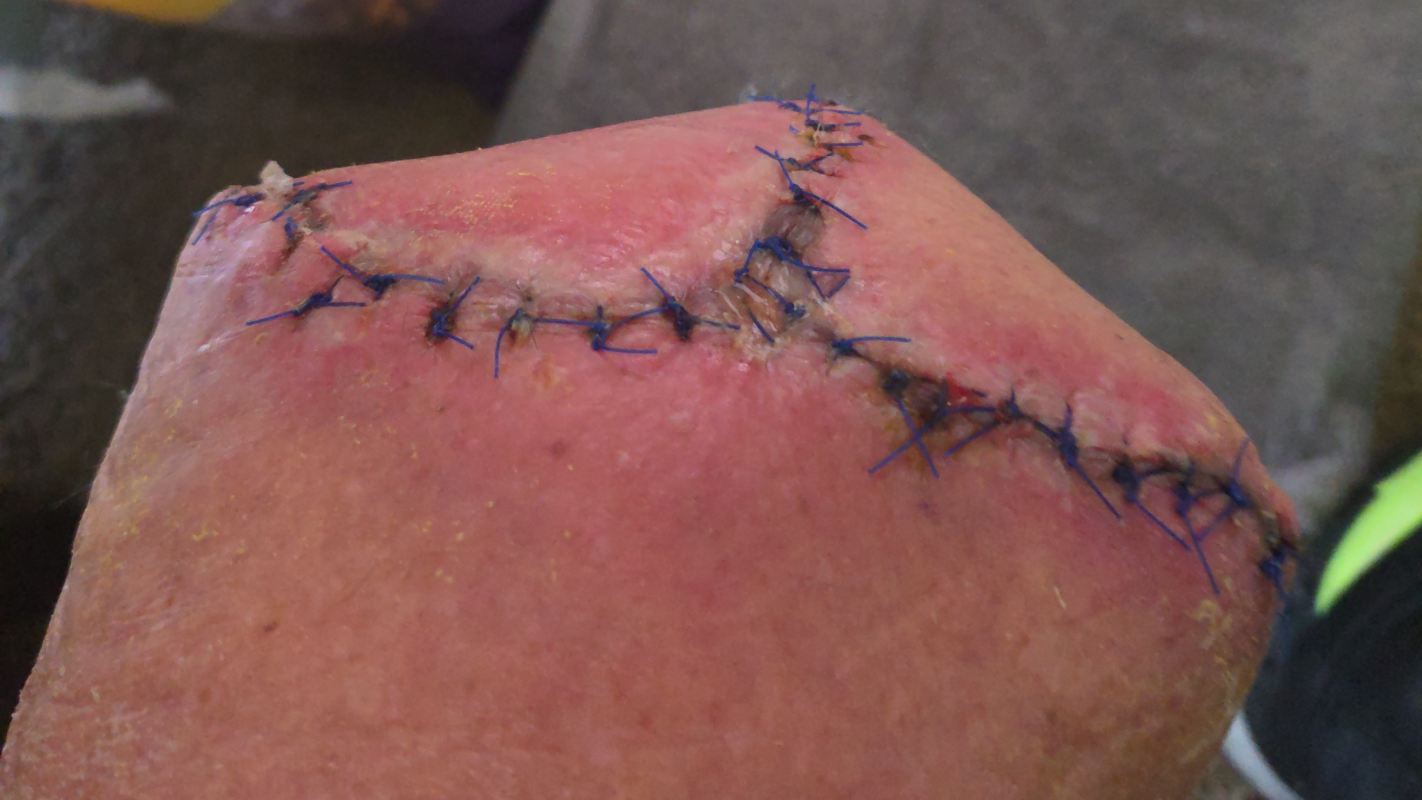 Recent amputation help getting back on my feet