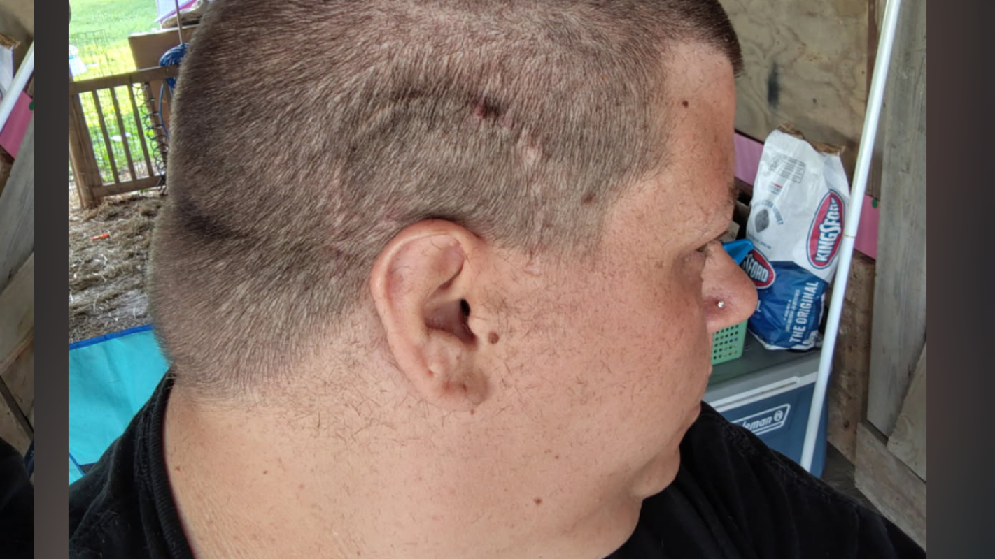 Brain cancer