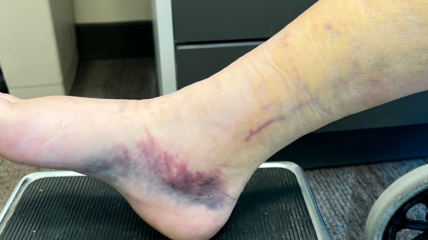 Recovery from broken ankle