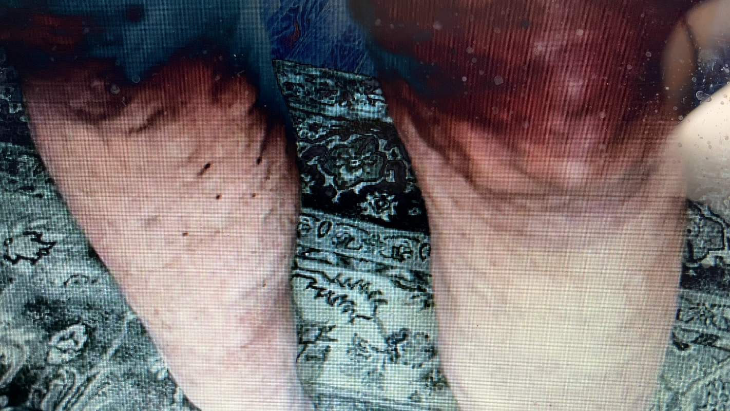 Help James Overcome Varicose Vein Pain