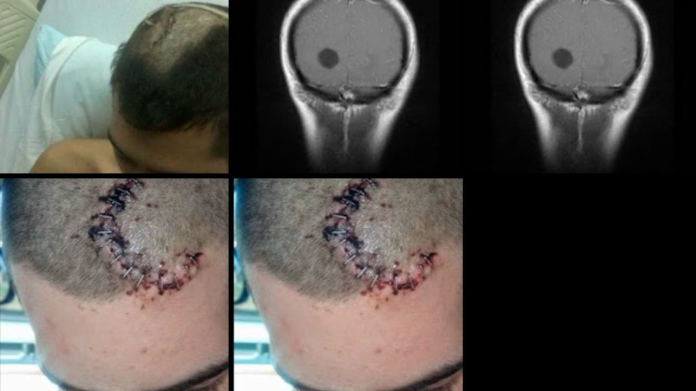 World’s Rarest Brain Tunor HELP:(