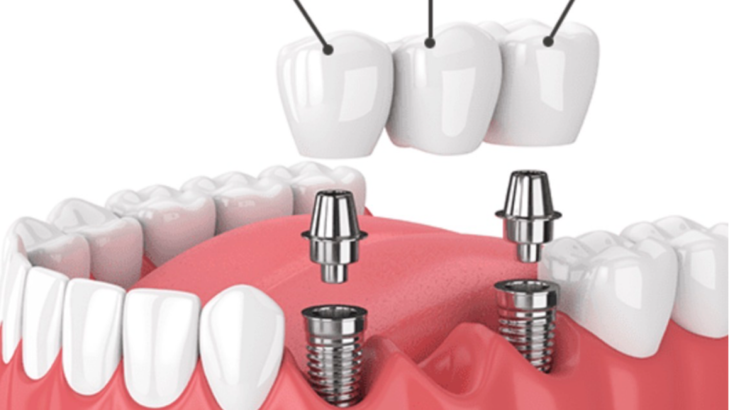 # Help Me Restore My Smile and My Health