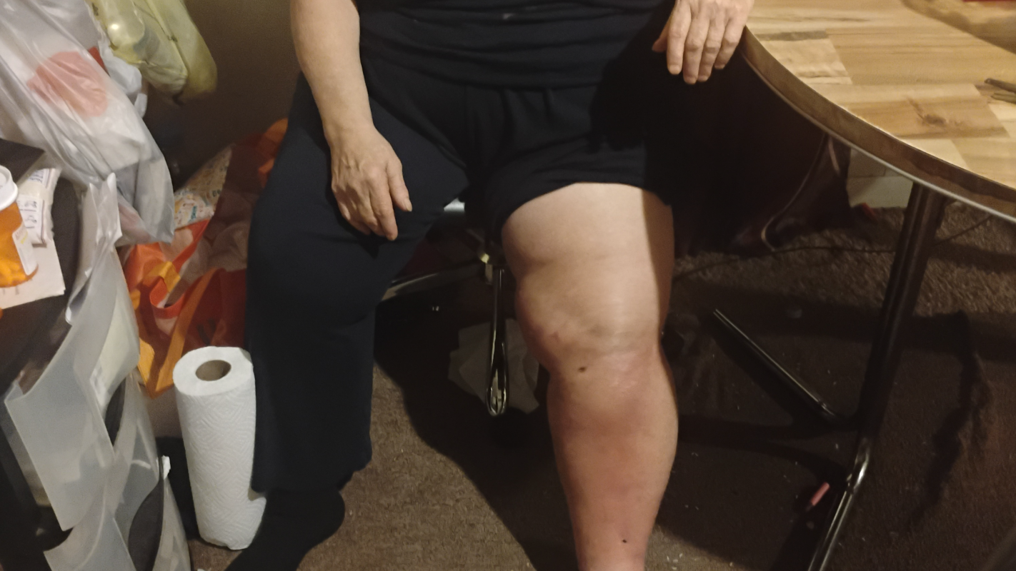 For my mother medical bills car accident