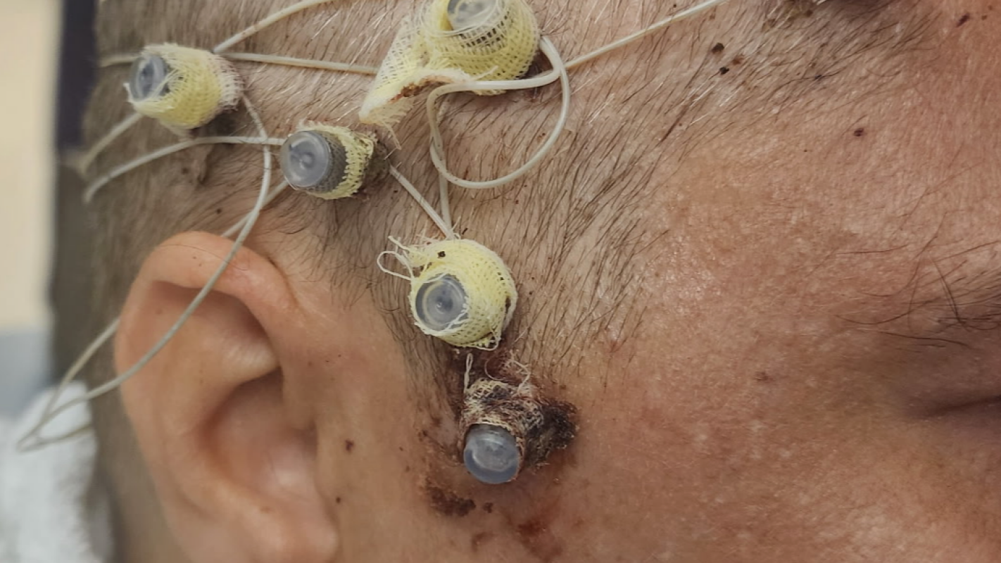 Brain surgery