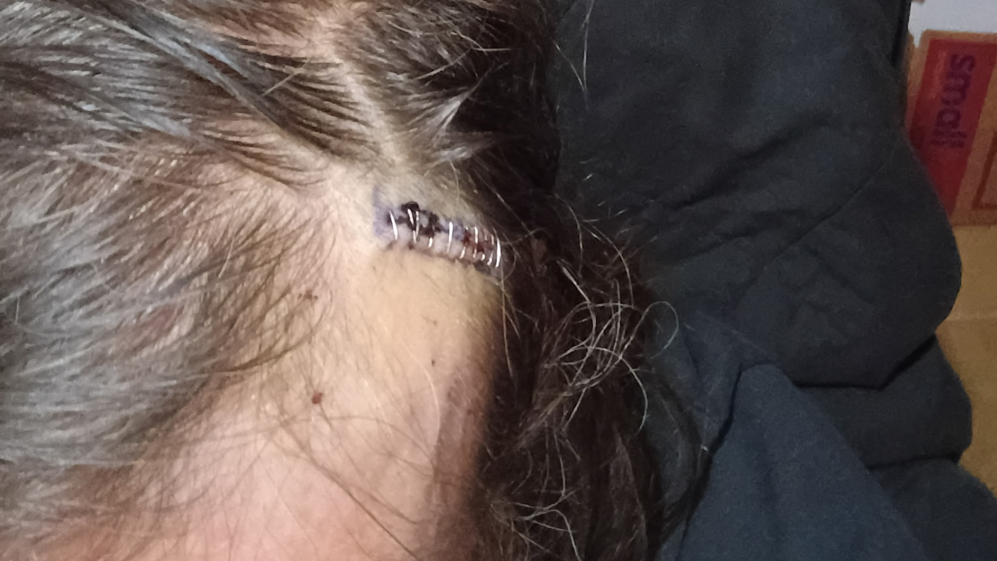 Jeffery C Miller Brain Tumor funding