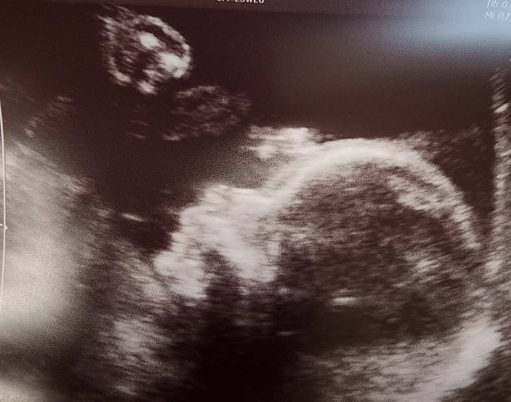 Baby Adalynne - Due 9/2/25