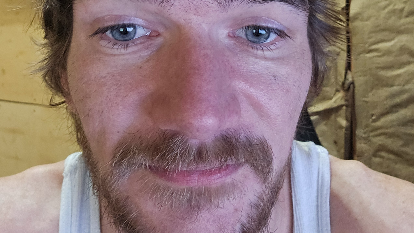 Help Tim smile again with dental implants