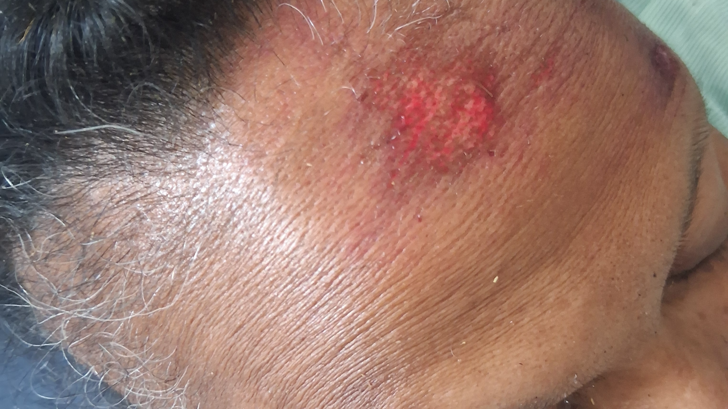 car accident injury