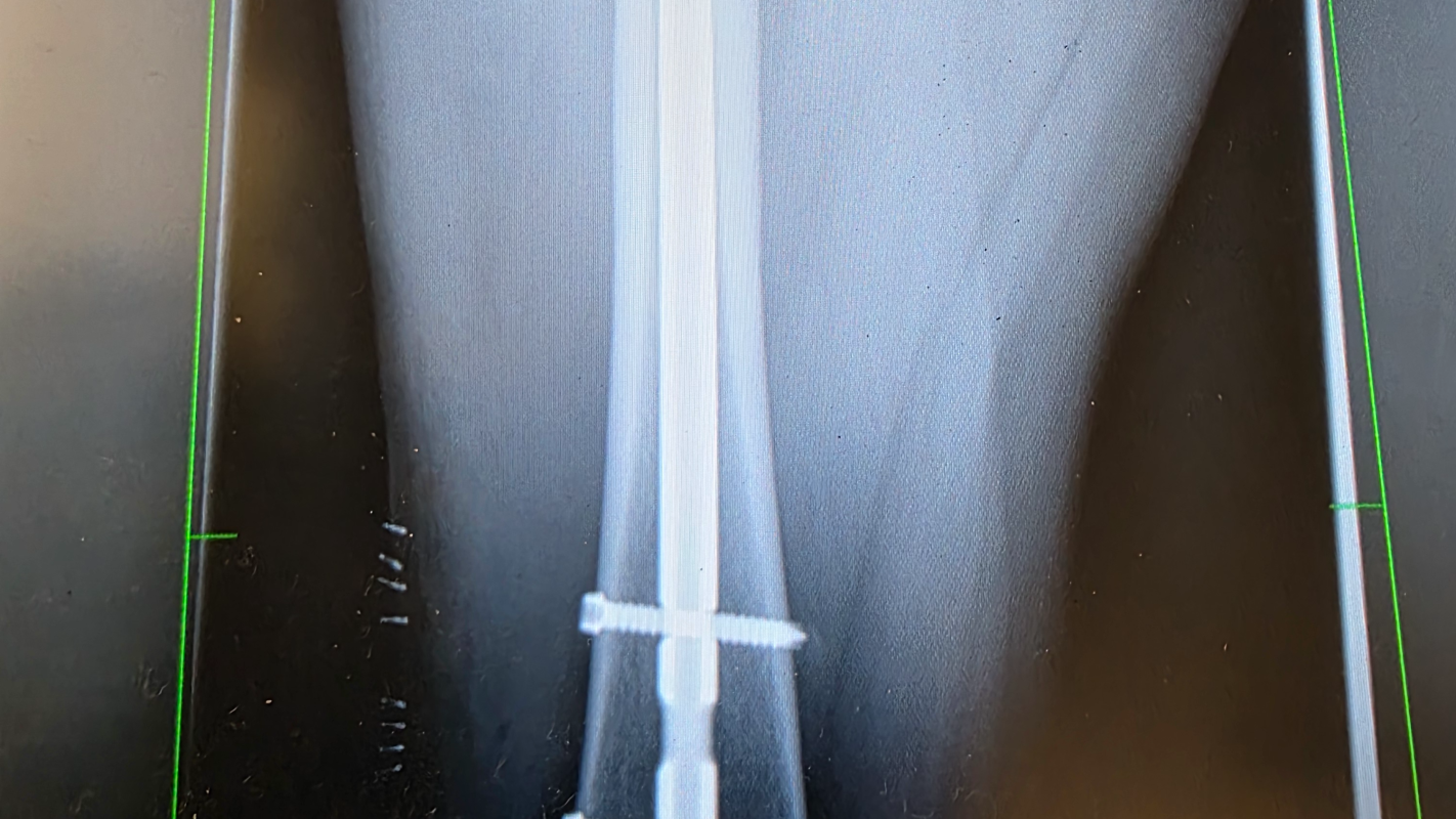 Broken Femur