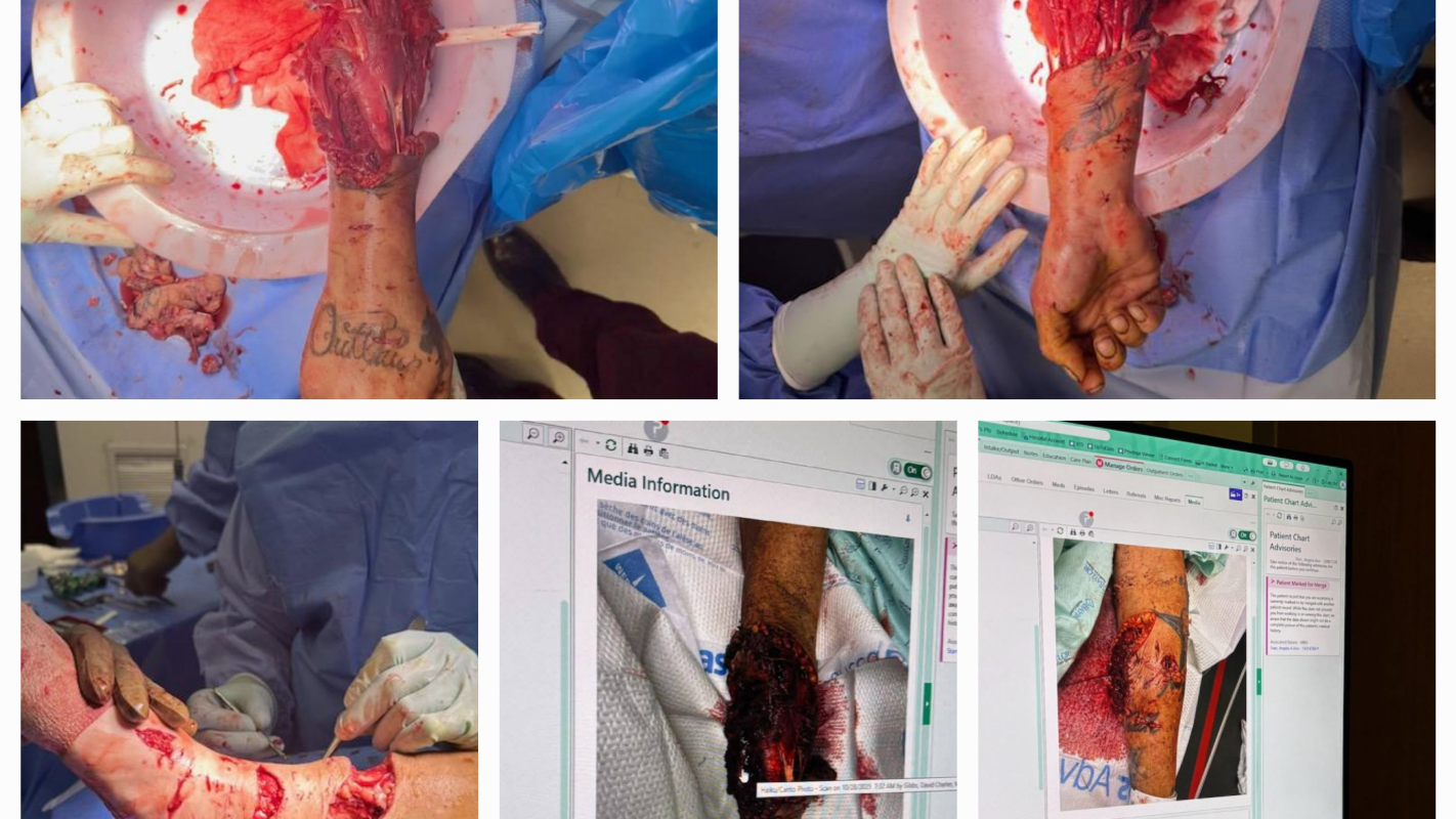 Reovery from a dog attack