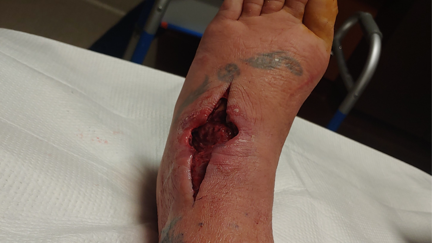 help After Surviving a Flesh-Eating Infection, I Nees help