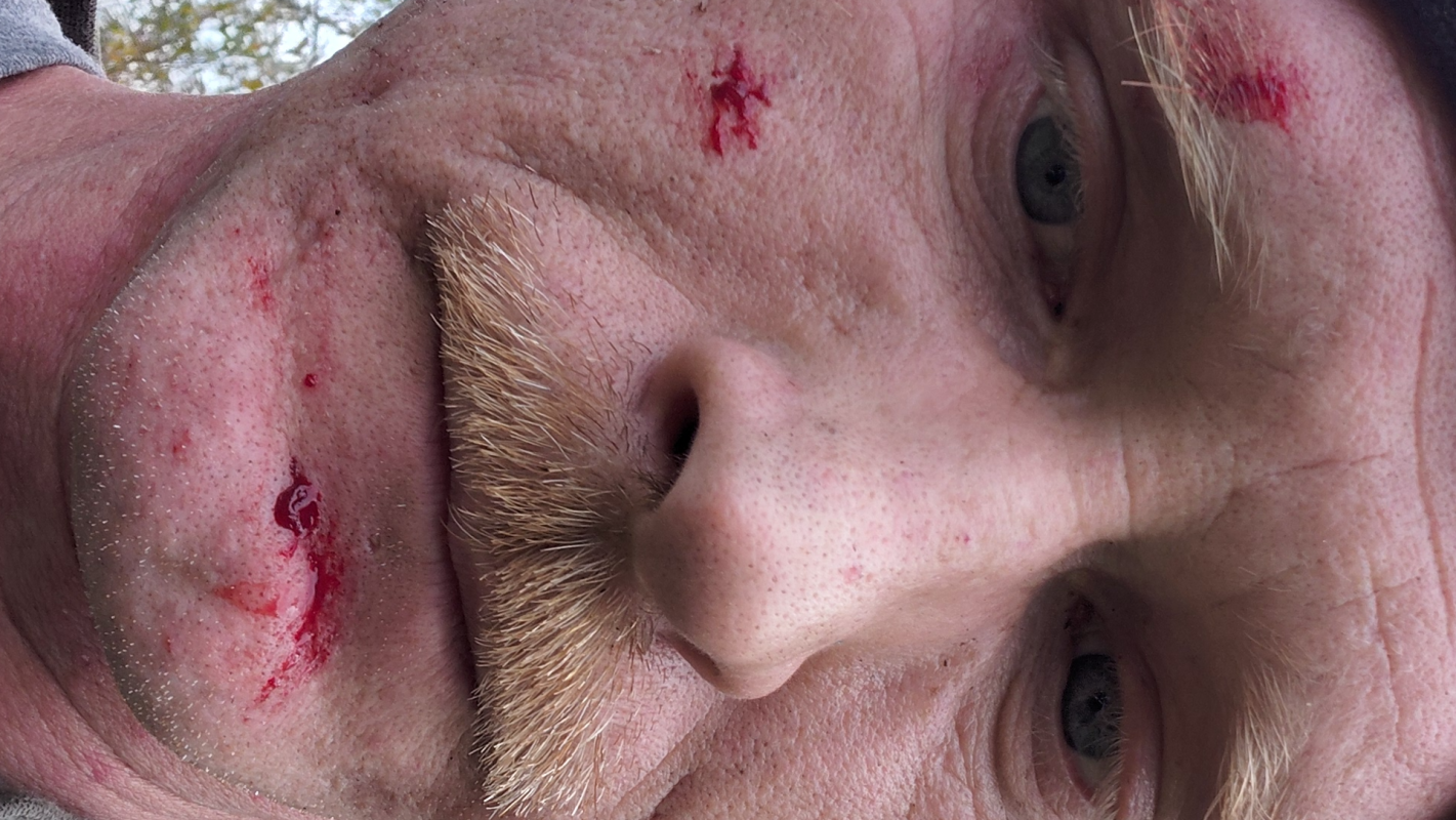 Car accident trauma 2